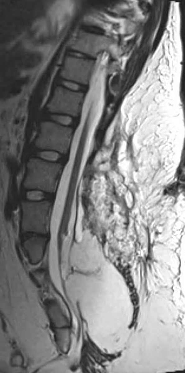 Lipomyelocele - CTisus CT Scan