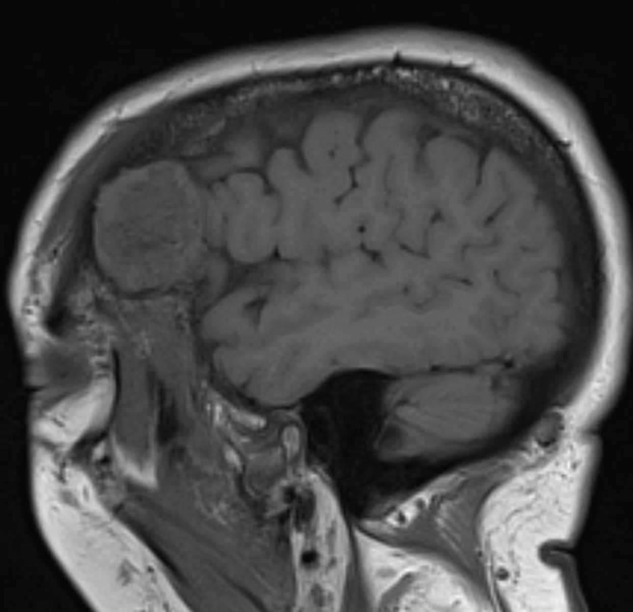 Metastases (Calvarium) (Thyroid) - CTisus CT Scan