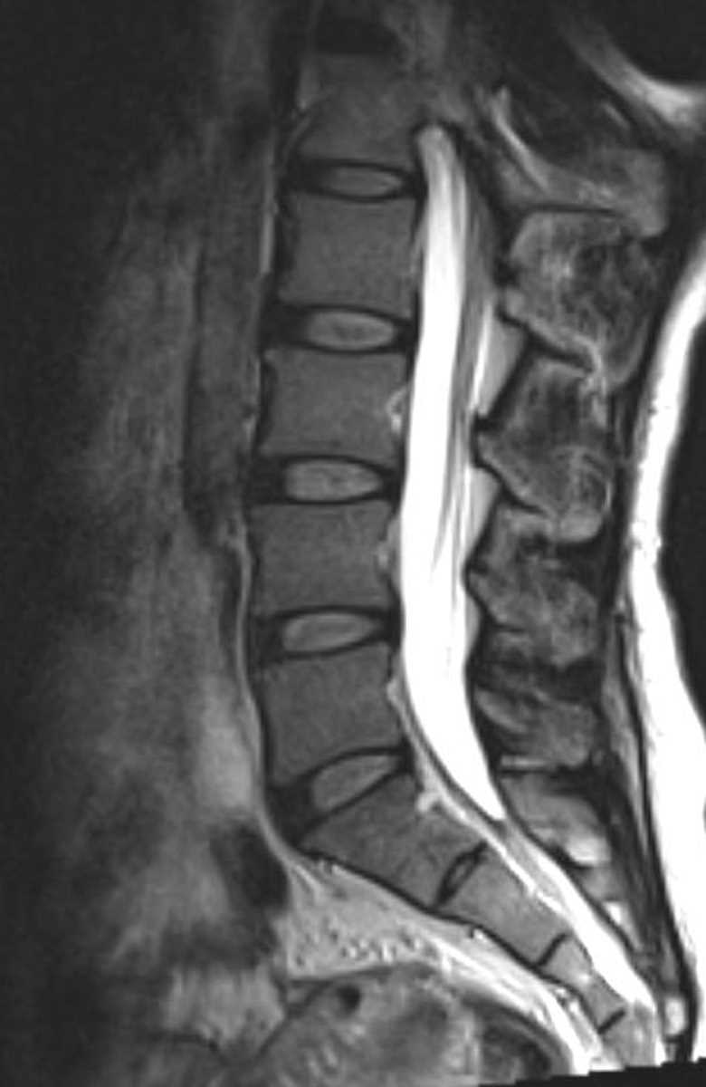 Metastases (HCC) - CTisus CT Scan