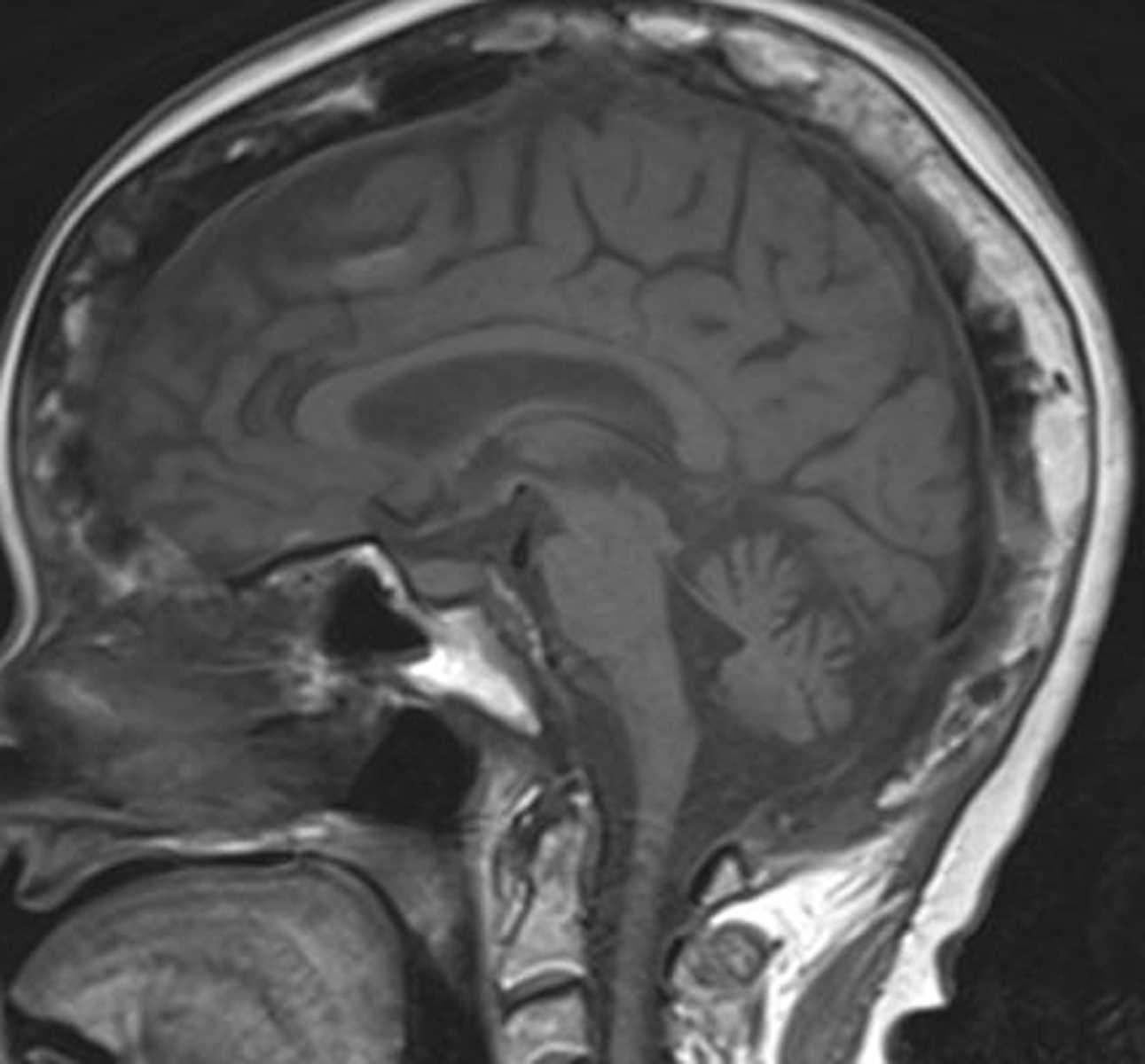 Paget's Disease - CTisus CT Scan