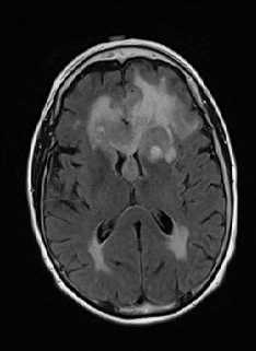 Primary CNS Lymphoma - CTisus CT Scan