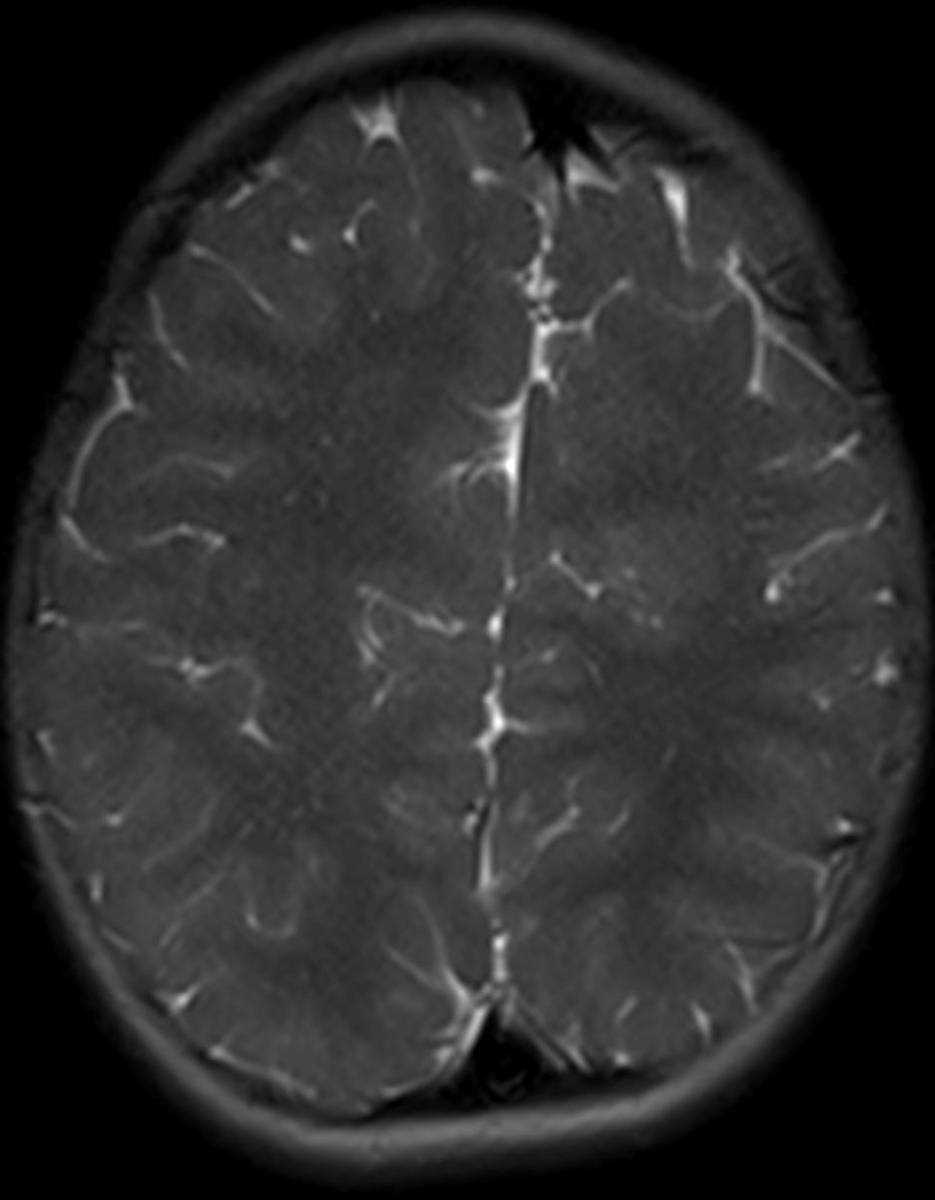 Callosal Agenesis - CTisus CT Scan