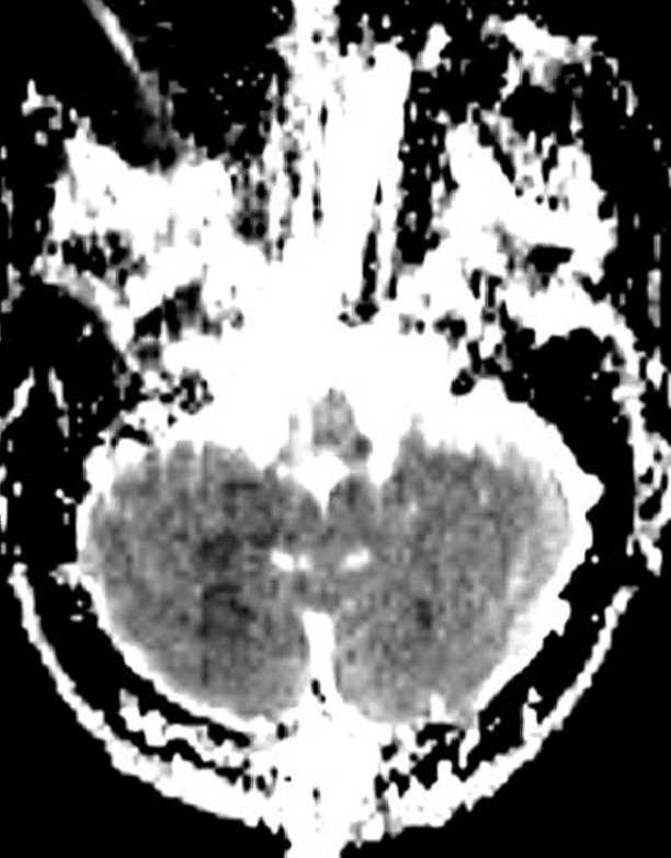 Embolic Infarcts - CTisus CT Scan