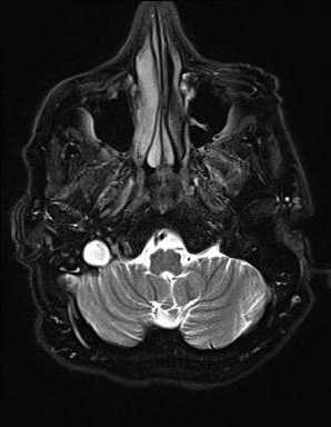 Transverse/Sigmoid Sinus Venous Thrombosis - CTisus CT Scan