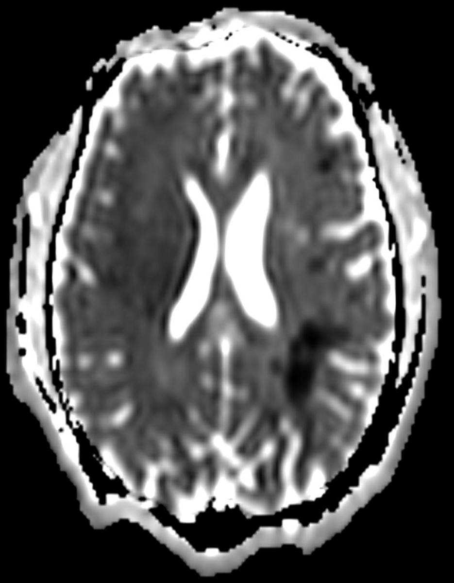 Moyamoya Secondary to Sickle Cell Disease - CTisus CT Scan