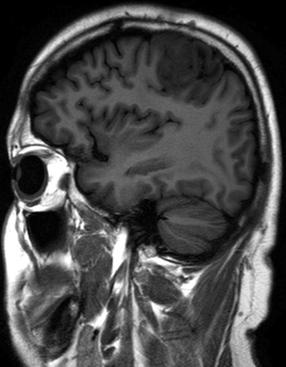 Low-grade Oligoastrocytoma - CTisus CT Scan