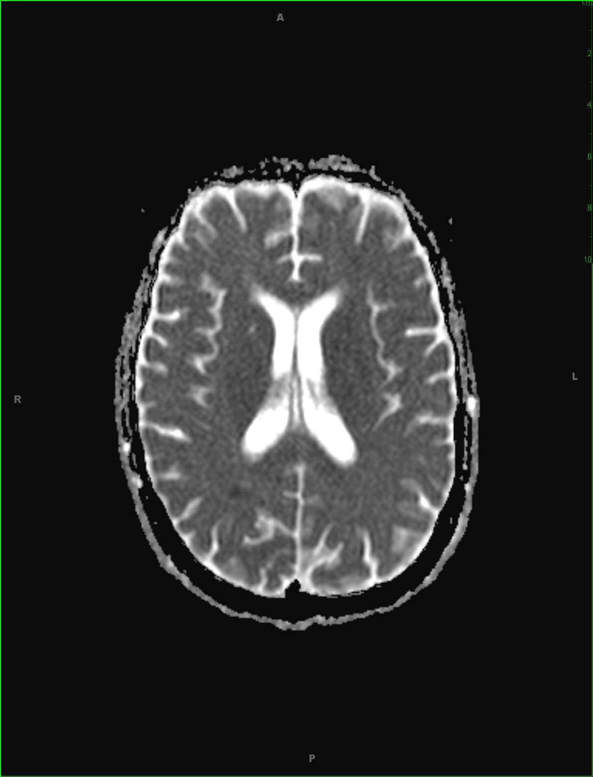 Varicella-Zoster Virus (VZV) Vasculitis - CTisus CT Scan