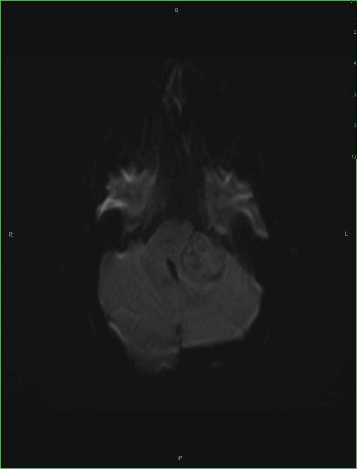 Vestibular Schwannoma - CTisus CT Scan