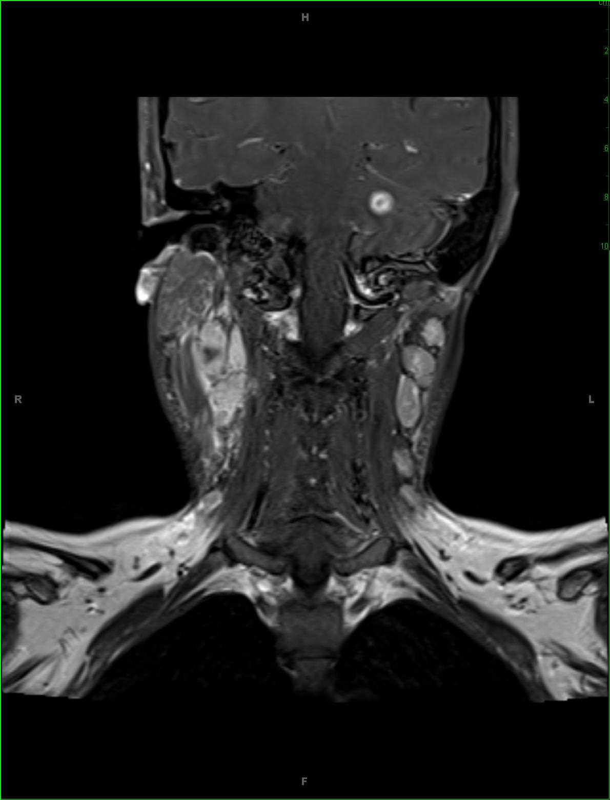 Tuberculous Tonsillitis and Tuberculoma - CTisus CT Scan