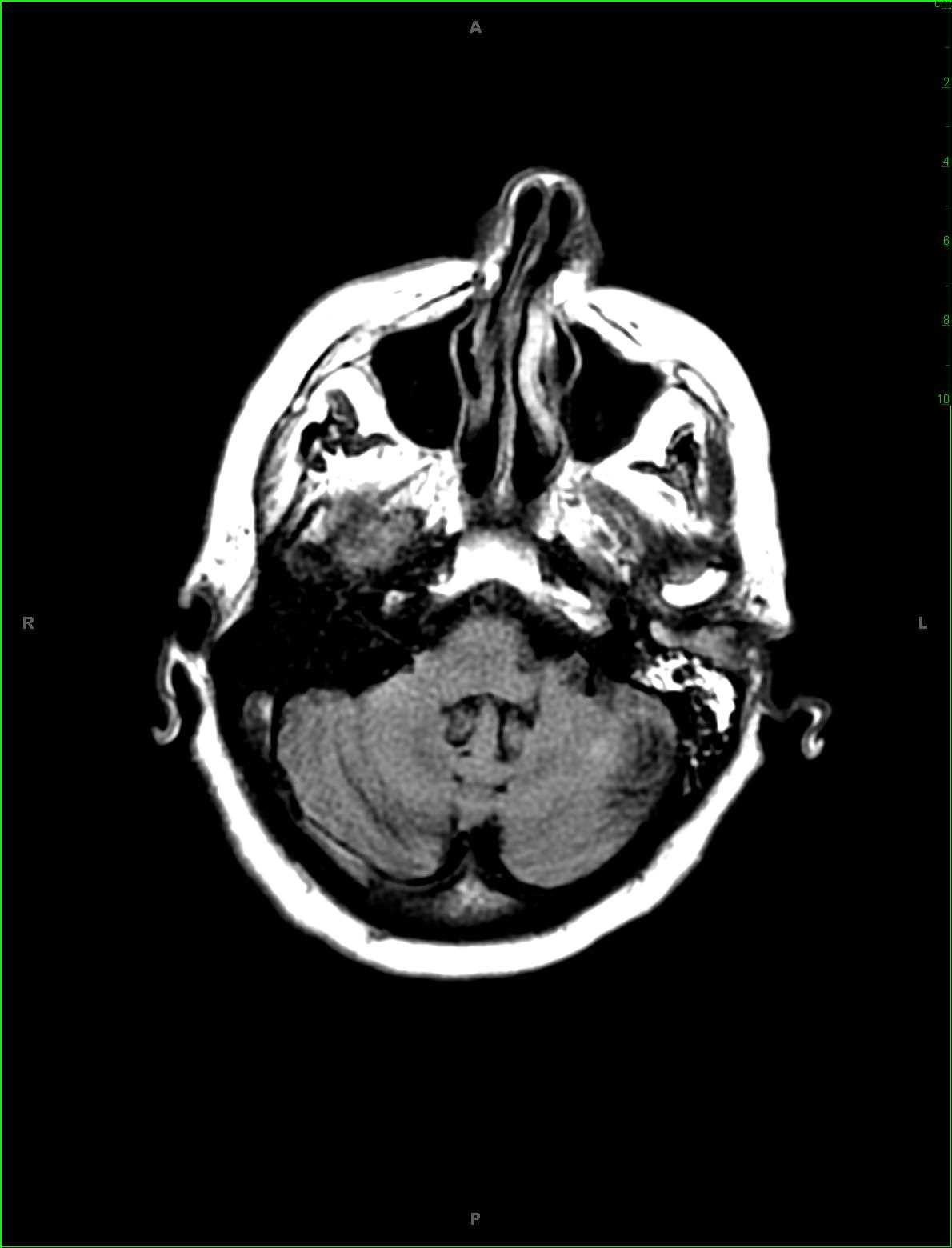 External Auditory Canal Adenoid Cystic Carcinoma - CTisus CT Scan