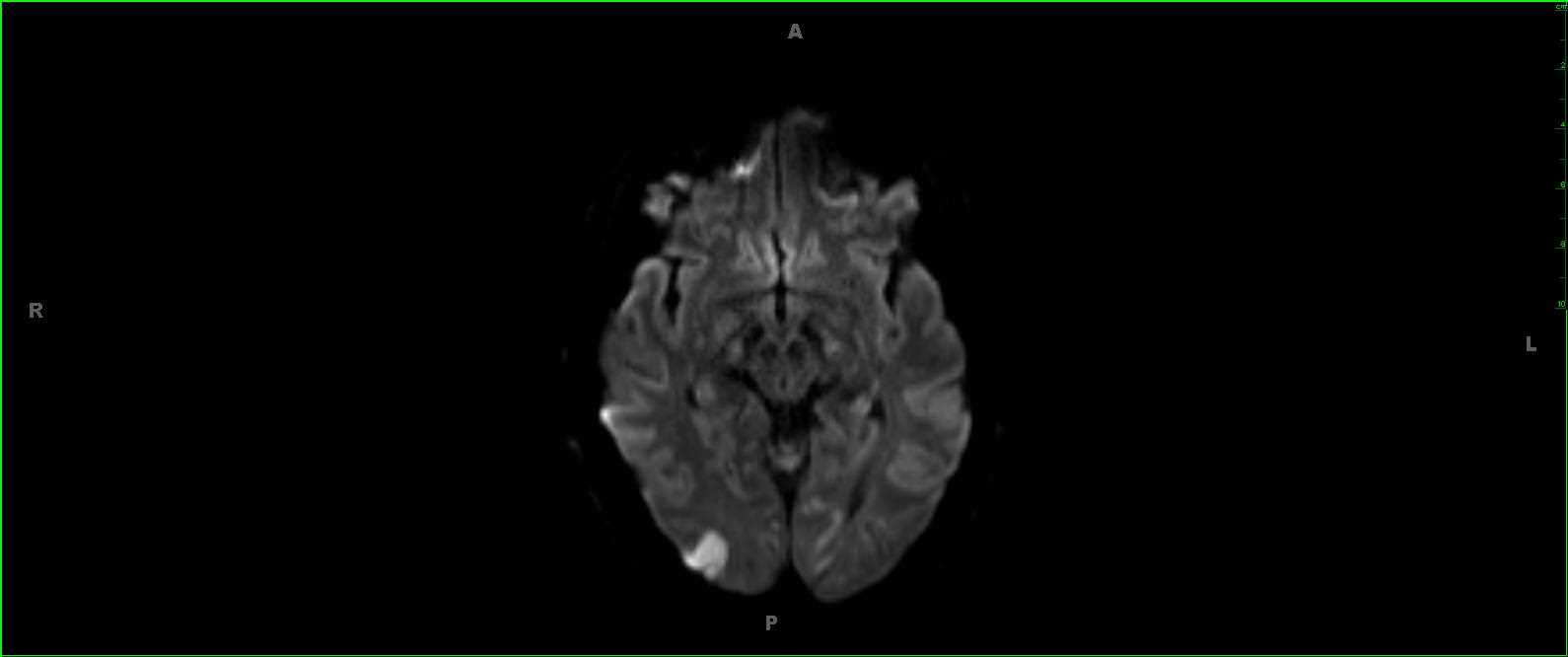 Seizures - CTisus CT Scan