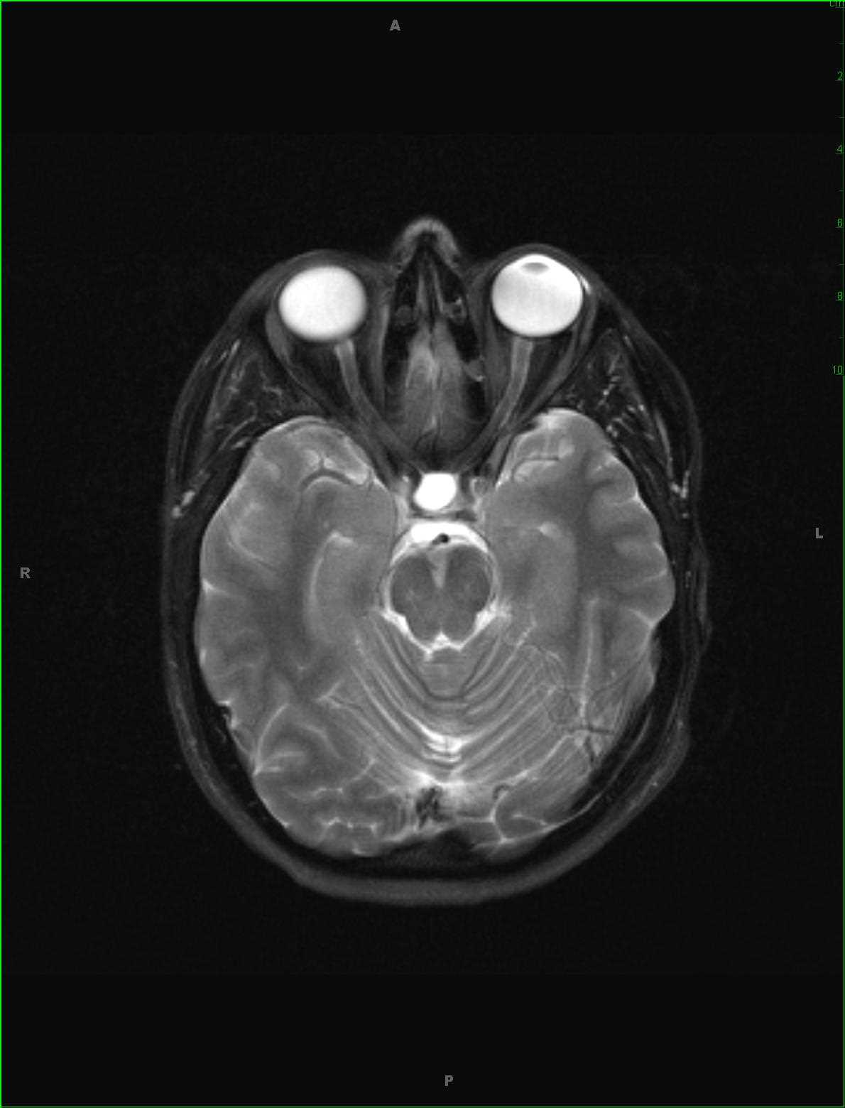 Rathke's Cleft Cyst - CTisus CT Scan