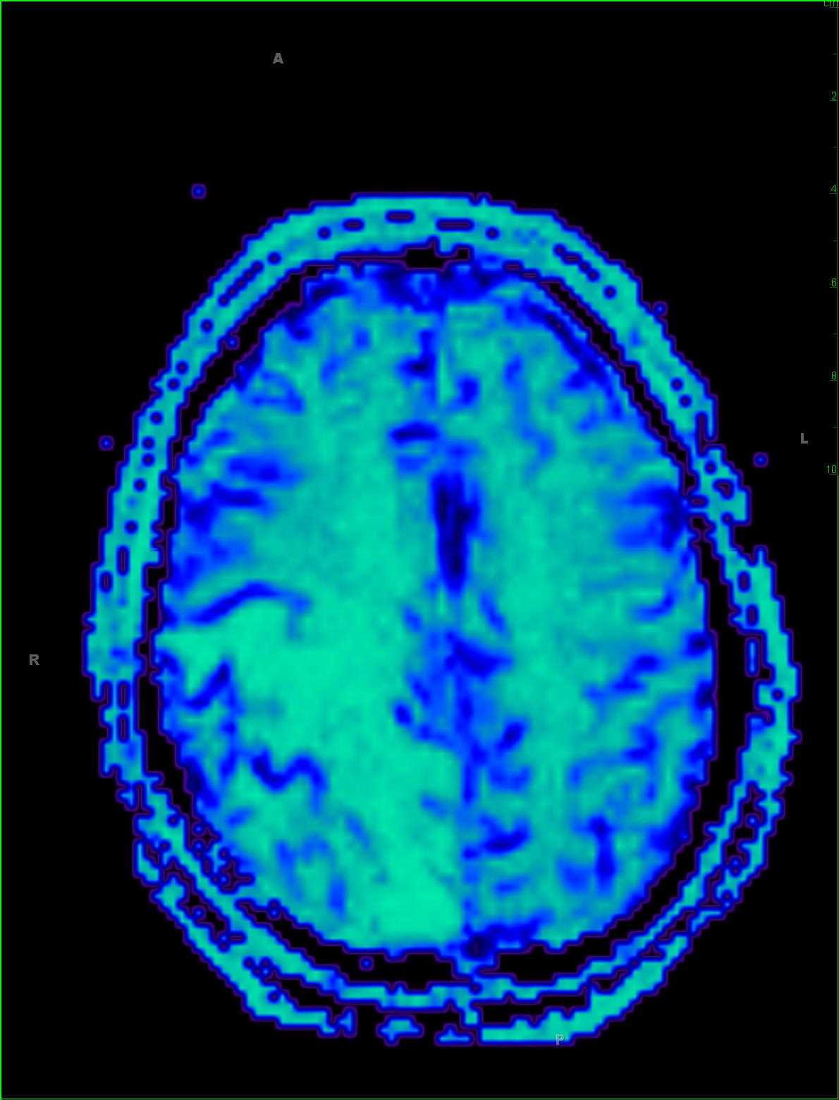 Hemorrhagic Infarct Secondary to Dural Sinus Thrombosis - CTisus CT Scan