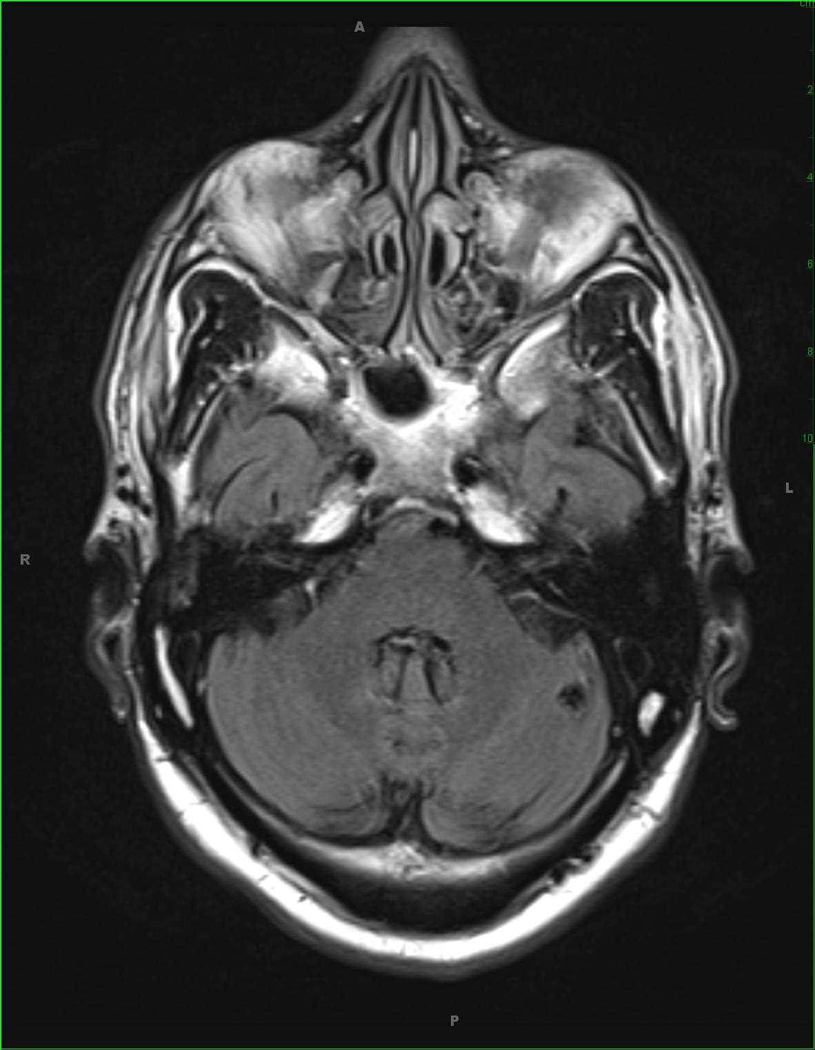 Cavernoma - CTisus CT Scan