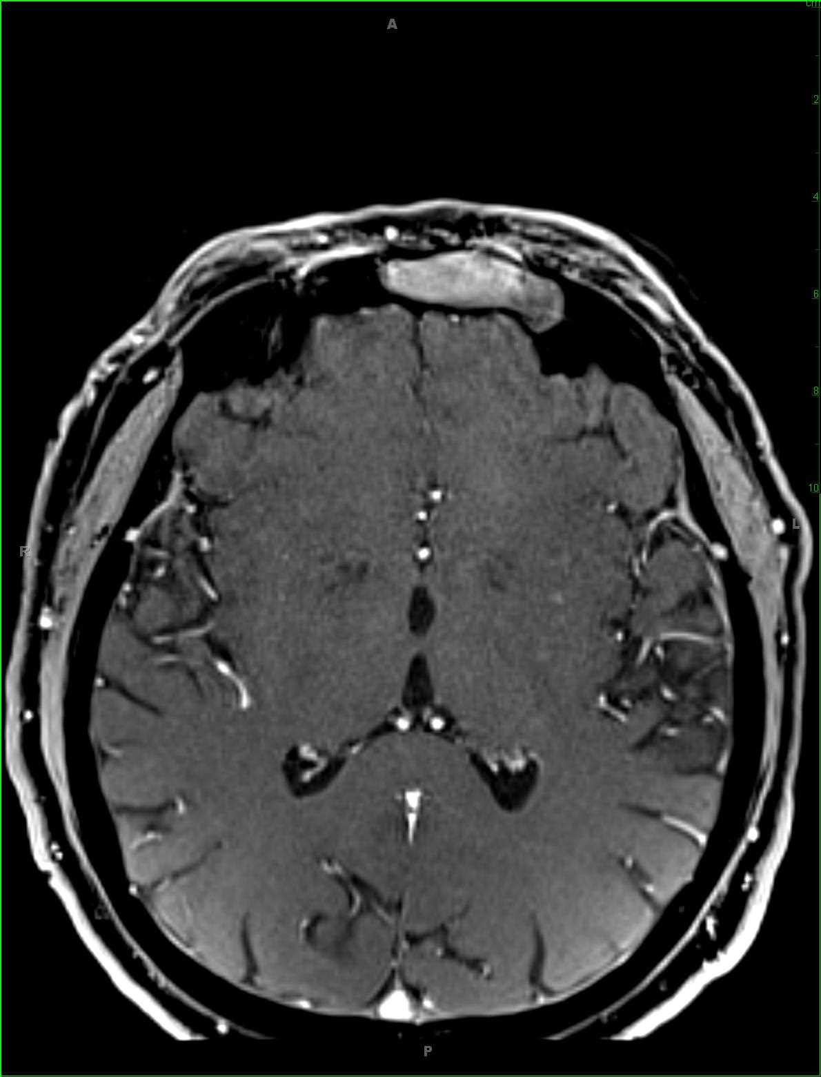 Mucocele - CTisus CT Scan