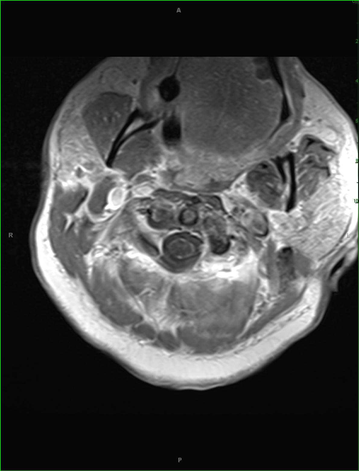 Meningitis, Spine - CTisus CT Scan