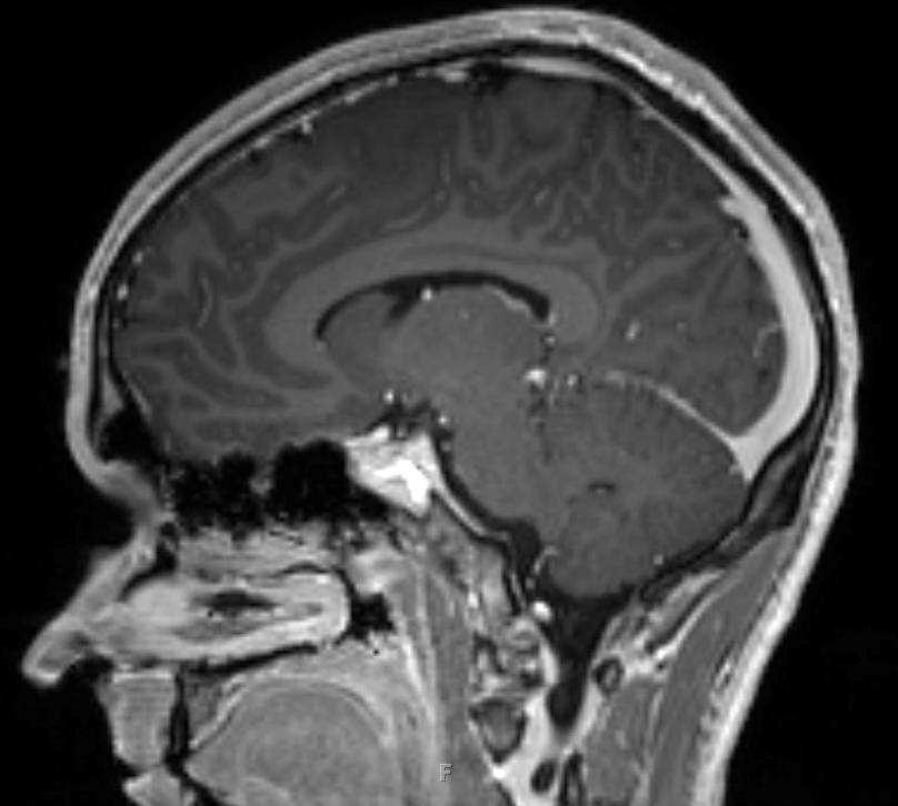 Low-grade Astrocytoma - CTisus CT Scan