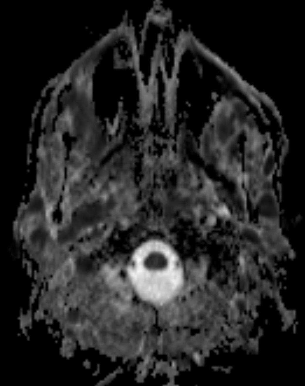 Chronic Lymphocytic Leukemia of the Maxillofacial Region - CTisus CT Scan