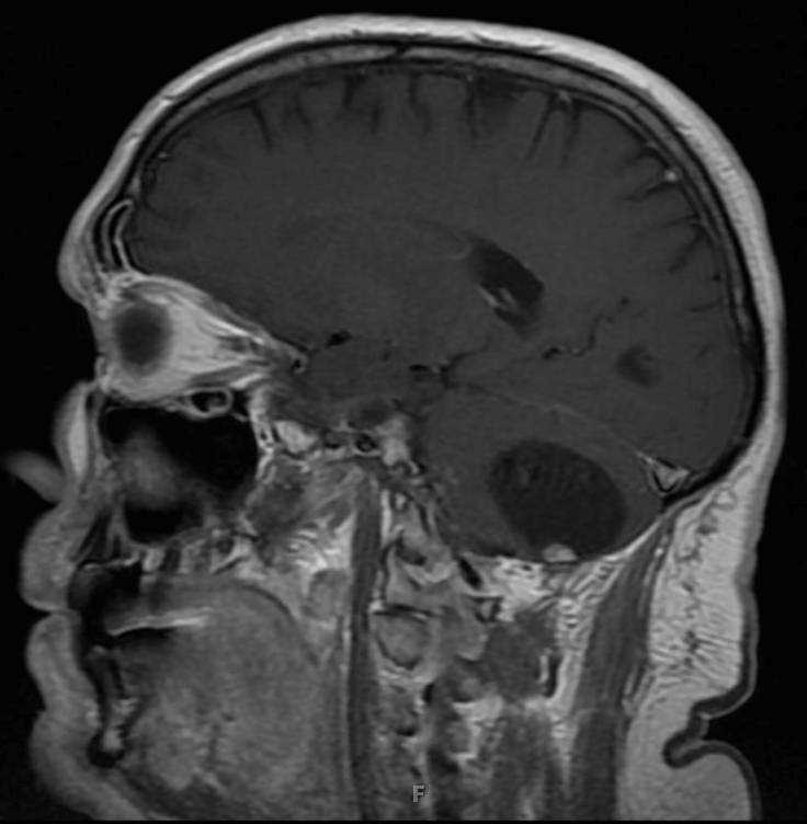 Hemangioblastoma - CTisus CT Scan