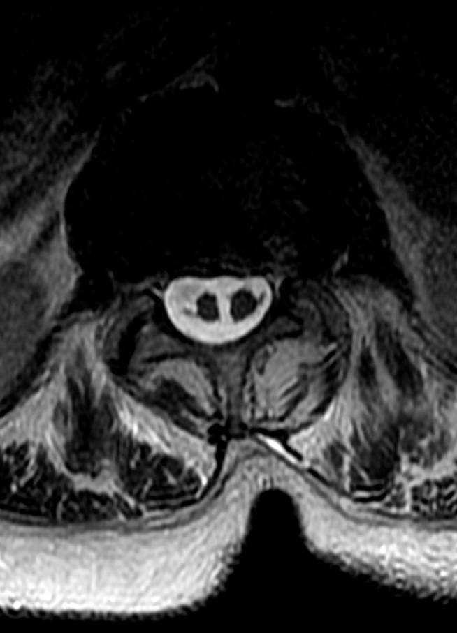 Diastematomyelia - CTisus CT Scan