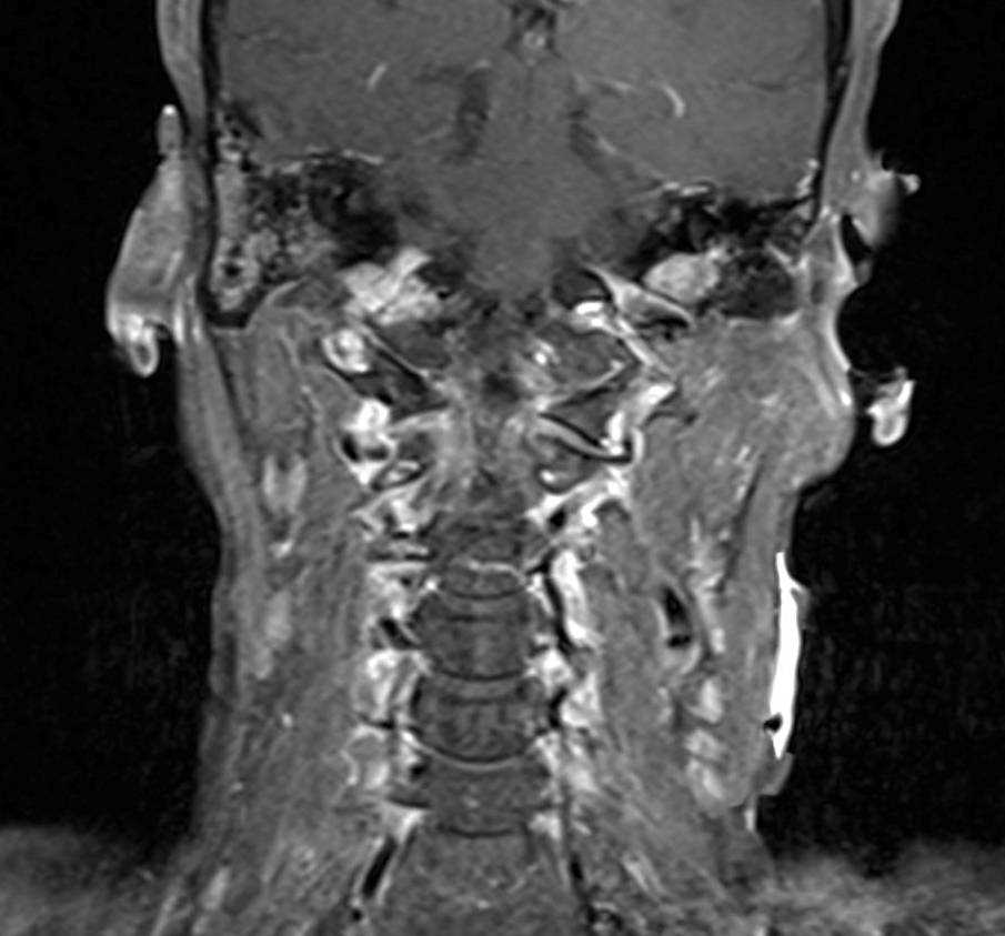 Glomus Jugulare - CTisus CT Scan