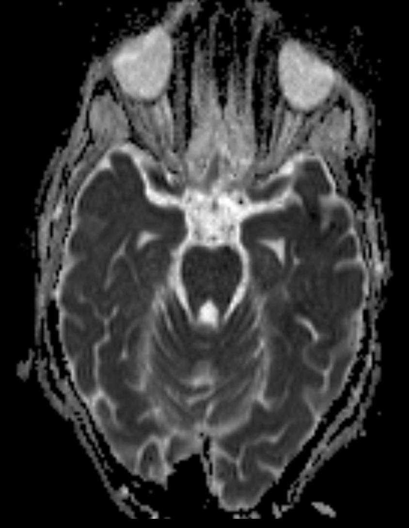 Paraneoplastic Limbic Encephalitis - CTisus CT Scan