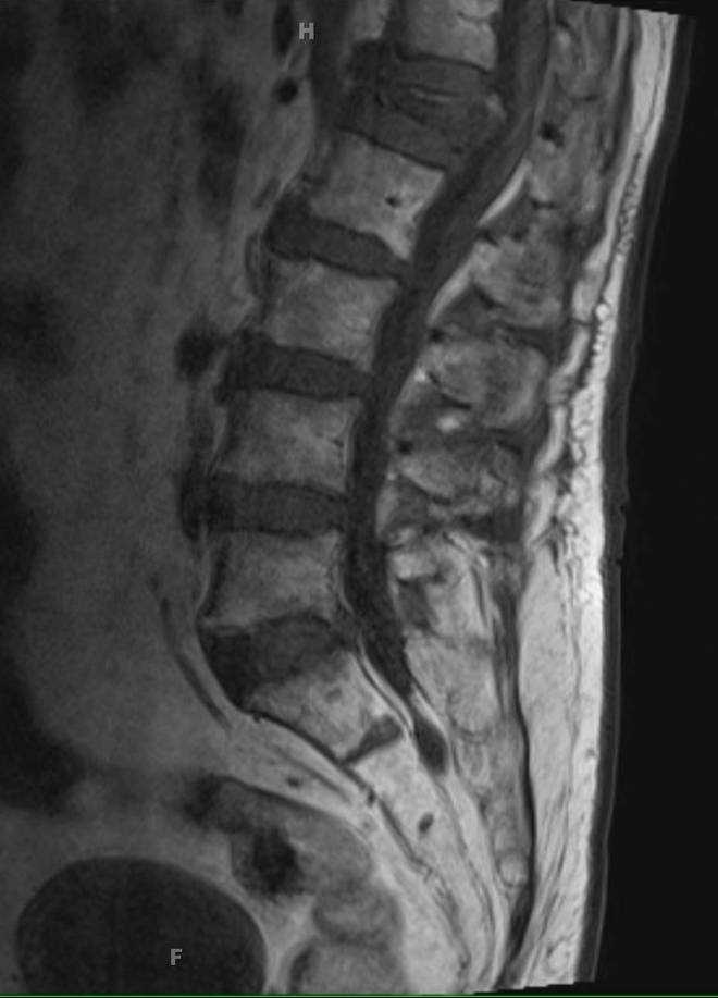 Lumbar Insufficiency Fracture - CTisus CT Scan