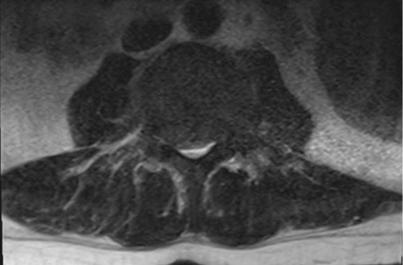 Extramedullary Hematopoiesis - CTisus CT Scan