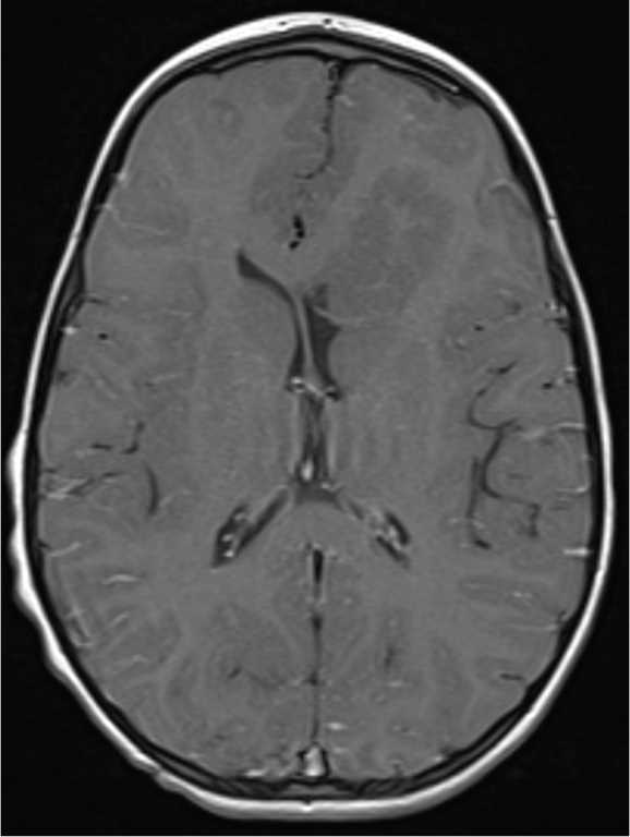 Cortical Dysplasia - CTisus CT Scan