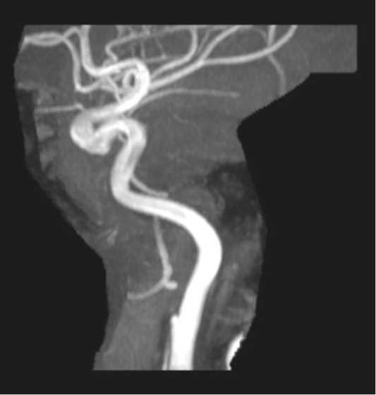 Cervical ICA Dissection and Pseudoaneurysm - CTisus CT Scan