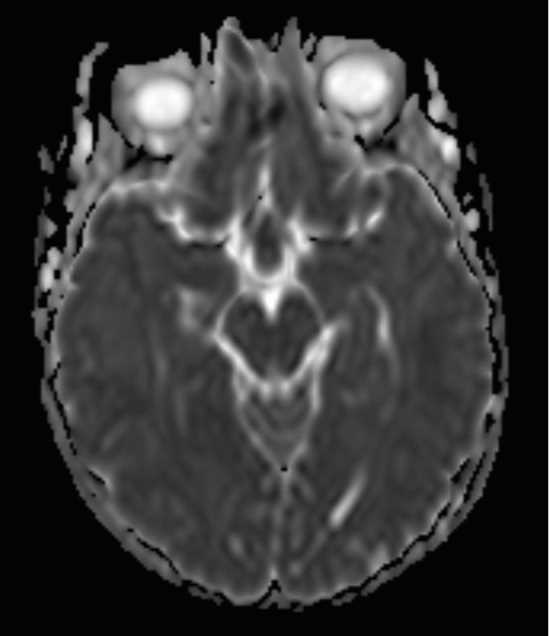Infundibular Germinoma - CTisus CT Scan