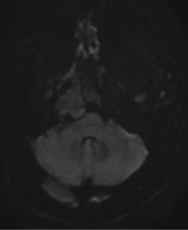 Chondrosarcoma, Skull Base - CTisus CT Scan
