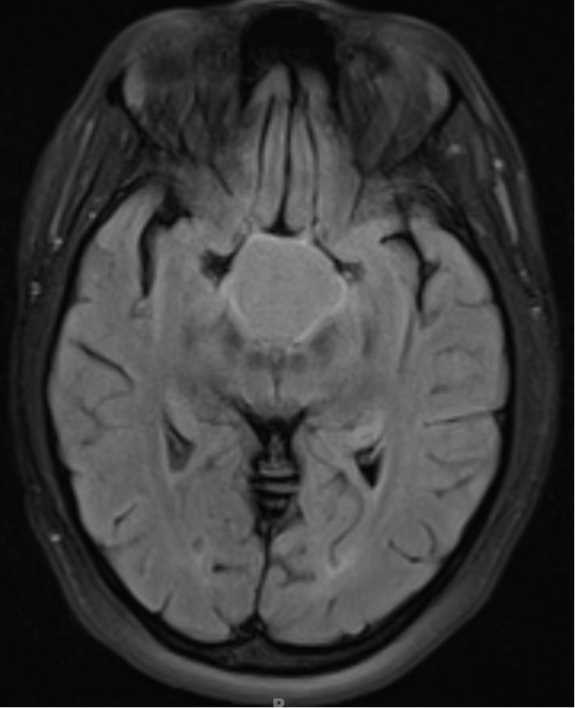 Adamantinomatous Craniopharyngioma - CTisus CT Scan