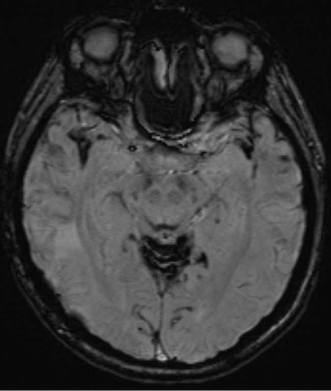 Superficial Siderosis - CTisus CT Scan