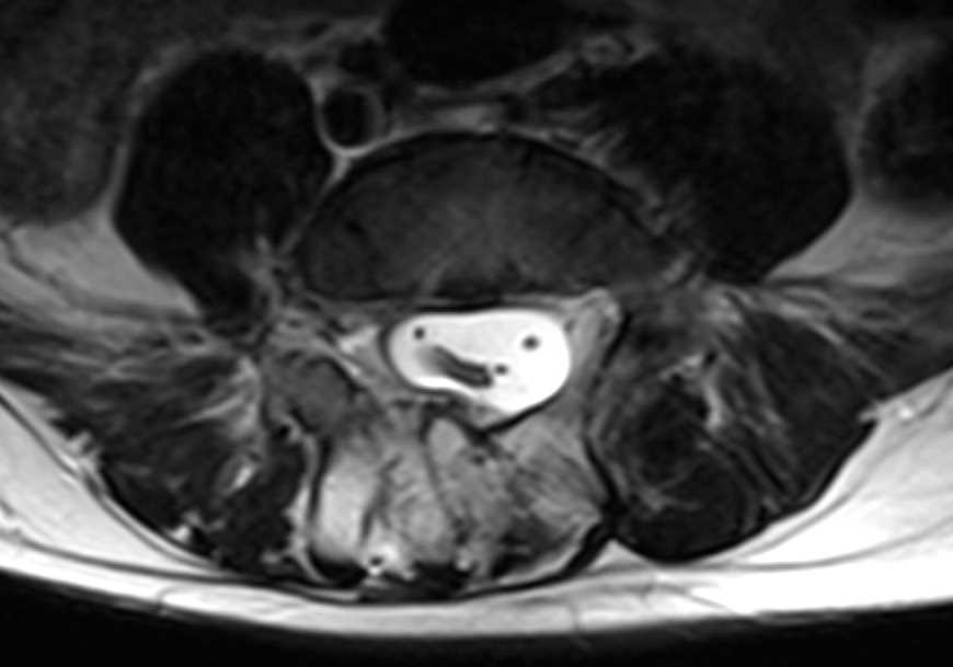 Hydromyelia and Diplomyelia - CTisus CT Scan
