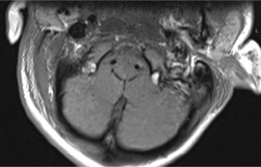 Retroclival Hematoma - CTisus CT Scan