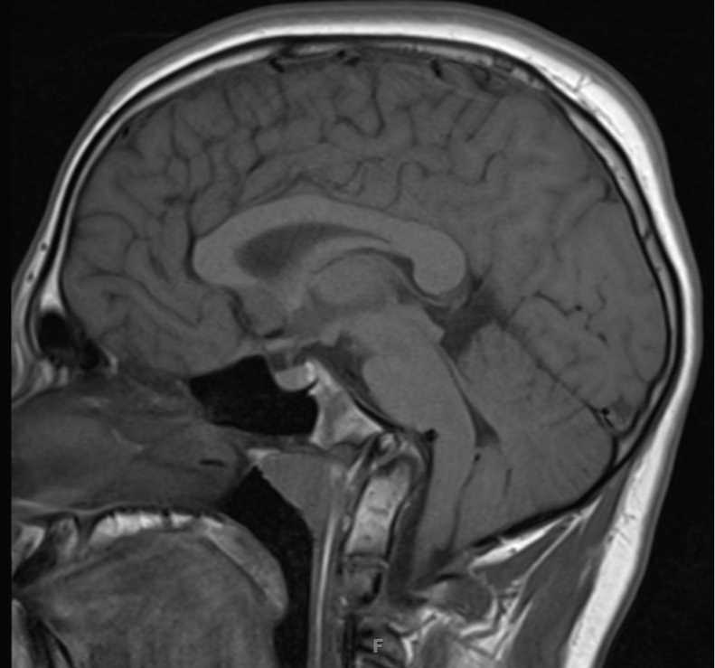 Basilar Impression - Neuro MR Case Studies - CTisus CT Scanning