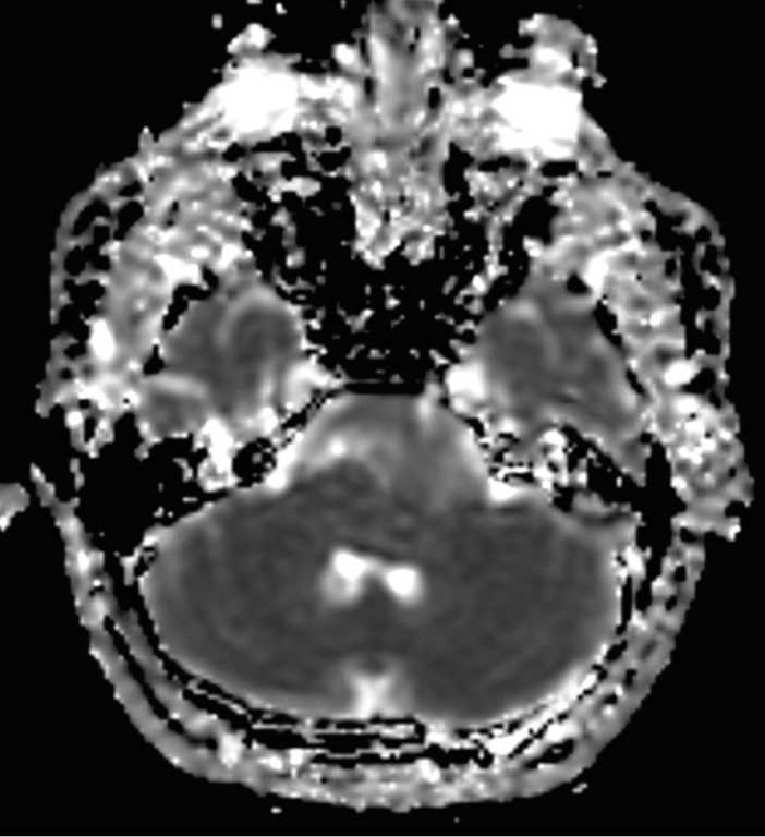 Cerebellopontine Angle Epidermoid - CTisus CT Scan