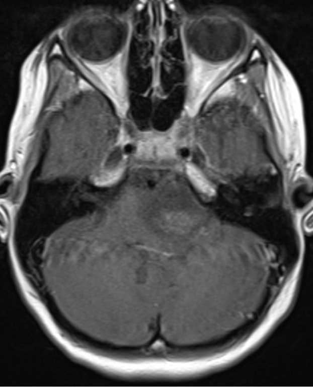 Pilocytic Astrocytoma - CTisus CT Scan