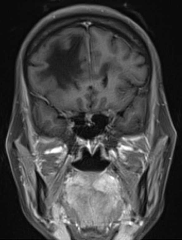 Progressive Multifocal Leukoencephalopathy - CTisus CT Scan