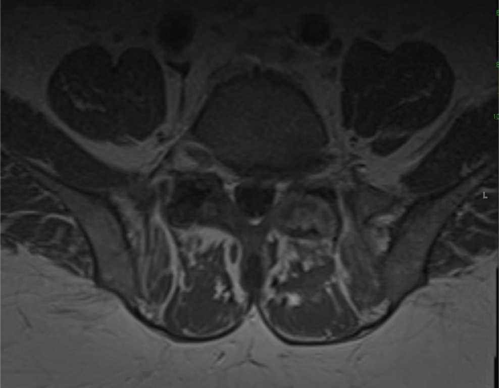 Septic Facet Arthritis - CTisus CT Scan