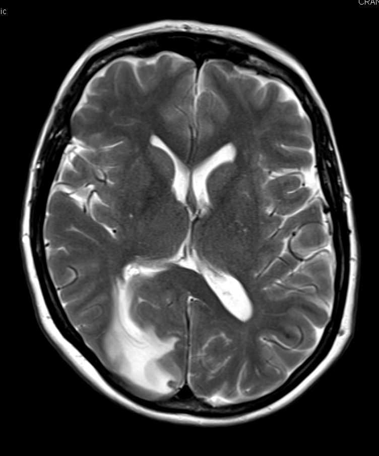 Brain Infarct - CTisus CT Scan