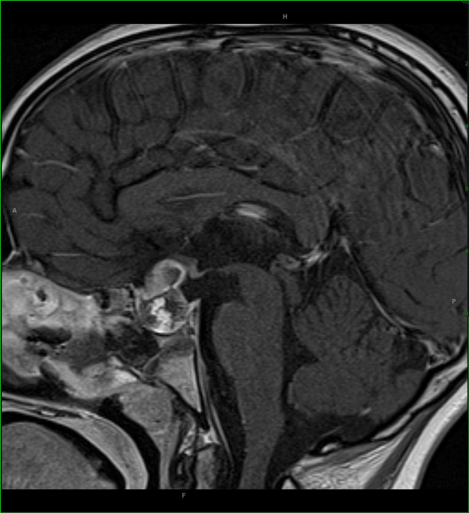 Craniopharyngioma, papillary - CTisus CT Scan