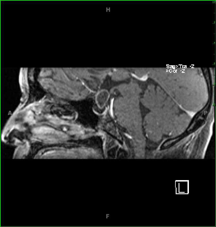 Craniopharyngioma, adamantinomatous - CTisus CT Scan