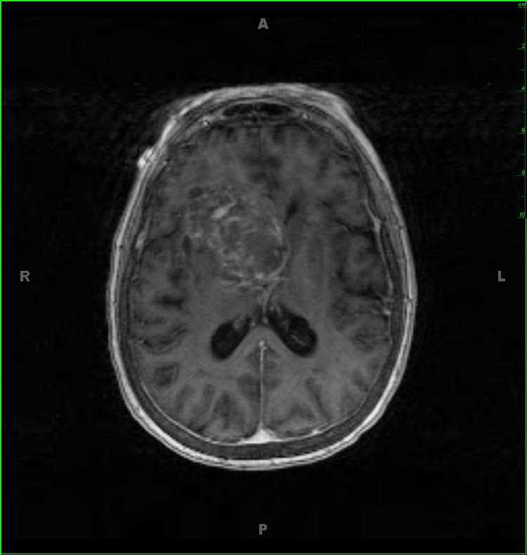 Glioblastoma - CTisus CT Scan