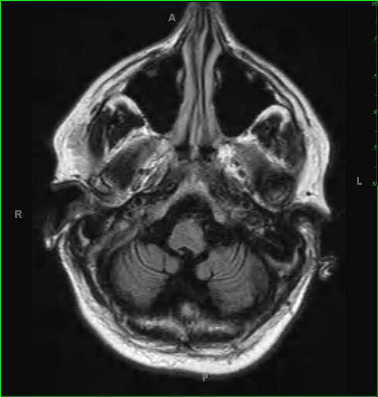 Paraneoplastic Cerebellar Atrophy - CTisus CT Scan