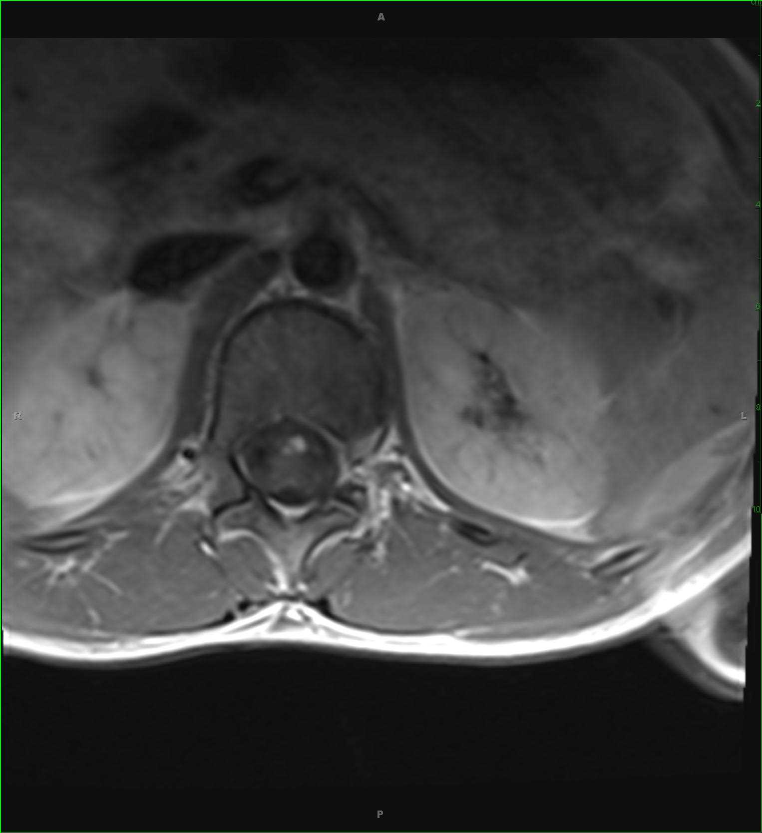 Spinal Cord Ependymoma - CTisus CT Scan