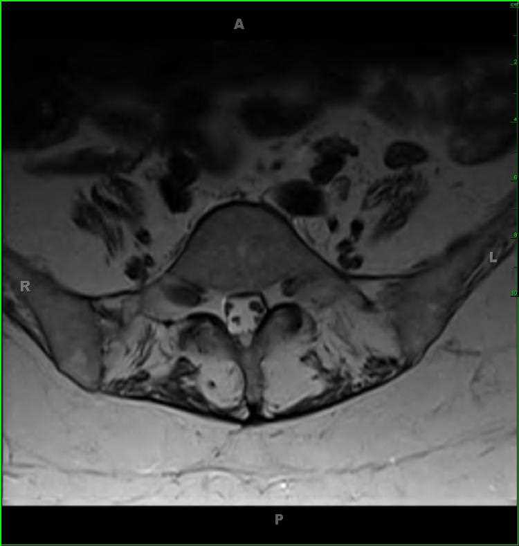 Charcot-Marie-Tooth Disease - Neuro MR Case Studies - CTisus CT Scanning