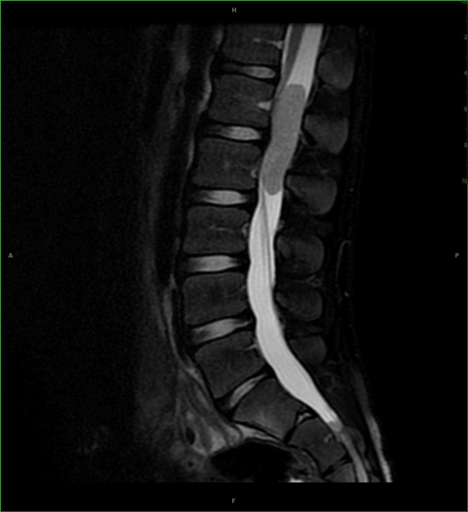 Spinal Myxopapillary Ependymoma - CTisus CT Scan