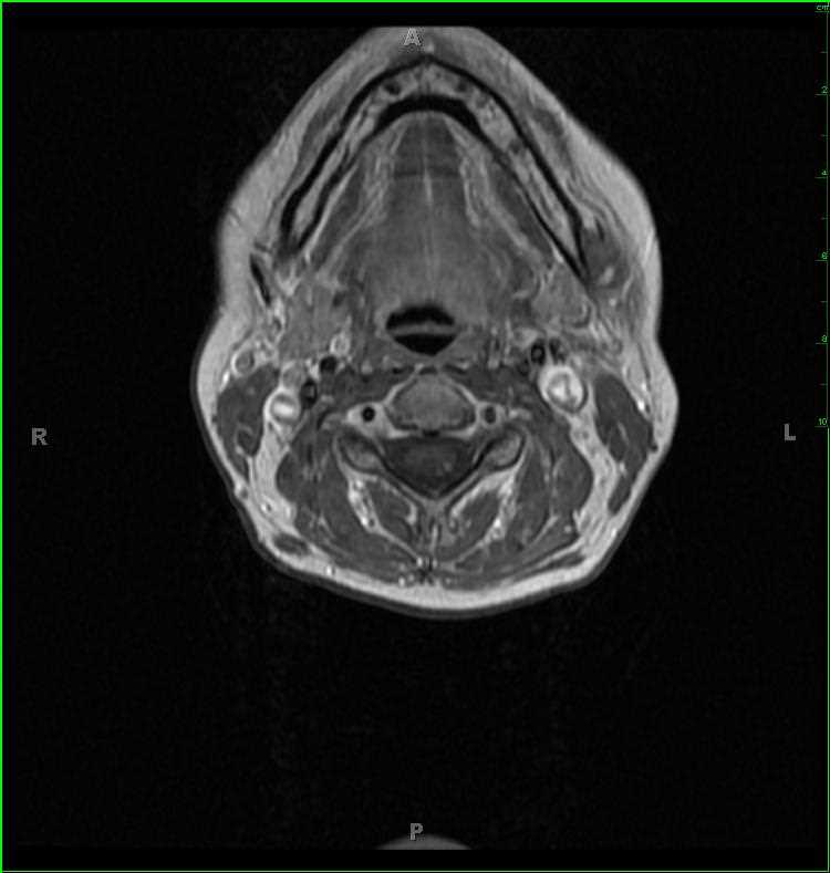 Spinal Cord Infarct, secondary to vertebral artery dissection - CTisus CT Scan